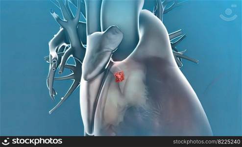 pulmonary embolism blood clotting 3D illustration. pulmonary embolism-blood clotting