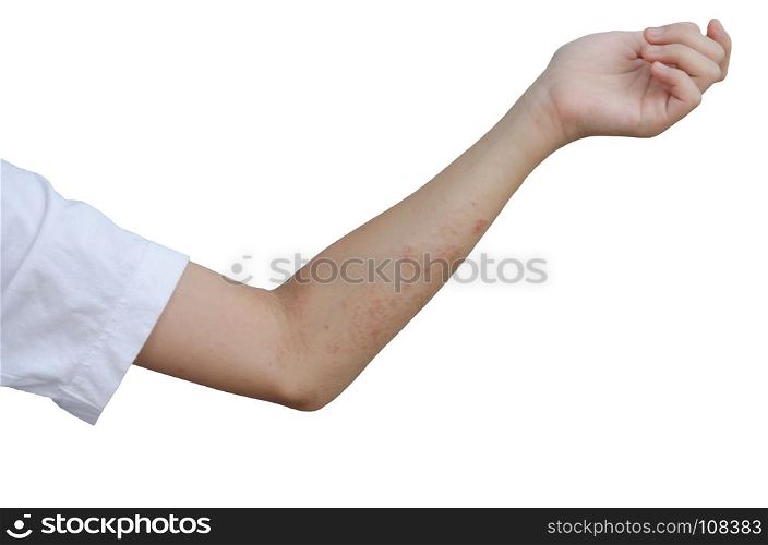 Rash and skin on the arms, isolated on white background.