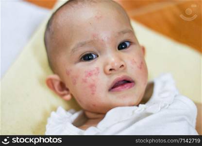 Rash baby allergy on face / disease baby girl face dry skin itching and lesion caused from allergy in newborn asia
