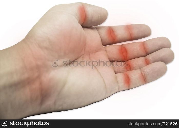 Rheumatoid Arthritis, Trigger finger, arthritis, wrist pain isolated on white background with Clipping part