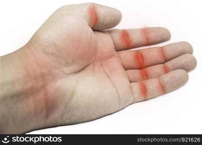 Rheumatoid Arthritis, Trigger finger, arthritis, wrist pain isolated on white background with Clipping part
