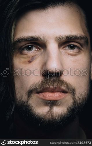 Sad man with black eye, violence domestic abuse concept