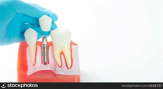 Sample dental model that has implants to replace the tooth that has been removed and has a preview of the crowns. Have a dentist&rsquo;s hand showing samples to patients with blank copy space area for text or slogan, against white background.