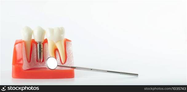 Sample dental model that has implants to replace the tooth that has been removed and has a preview of the crowns. Have a dentist&rsquo;s hand showing samples to patients with blank copy space area for text or slogan, against white background.