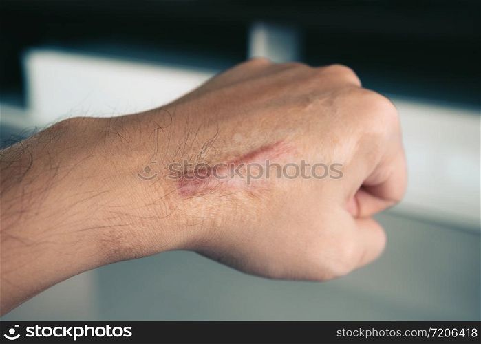 Scar on human skin keloid on hand.