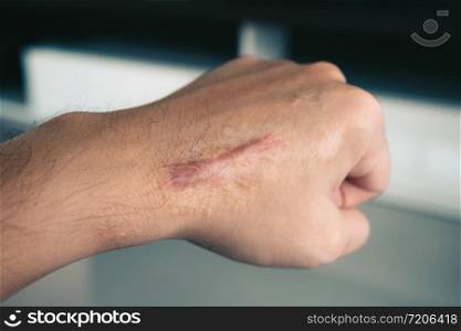 Scar on human skin keloid on hand.