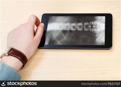 scientist analyzes X-ray picture of vertebral column on screen on tablet pc