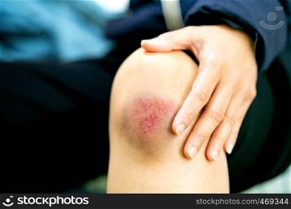 scratch wound on female knee closeup, healthcare and medicine concept