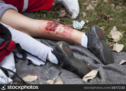 Serious injury on girl&rsquo;s leg