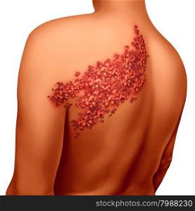 Shingles disease viral infection concept as a medical illustration with skin blisters hives and sores on a human back torso as a health symbol for a painful rash condition.