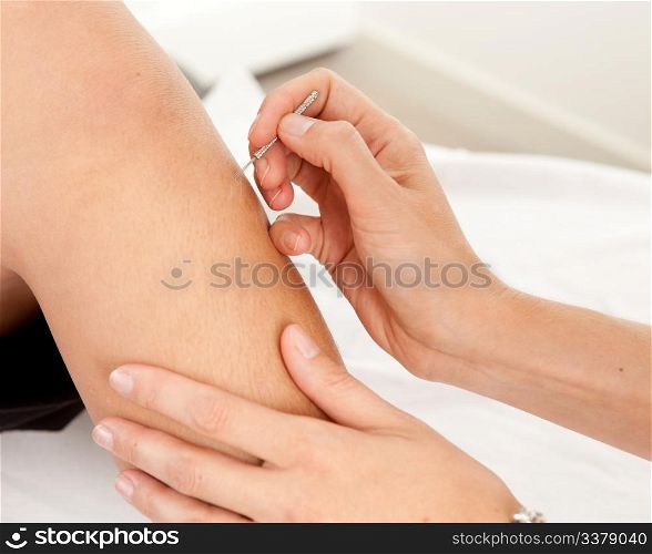 Shonishin pediatric acupuncture on a young boy&rsquo;s leg
