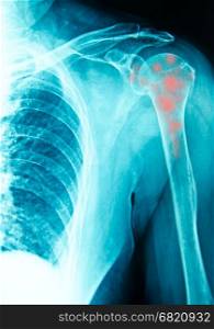 shoulder x-ray for diagnosis with inflamatory bone