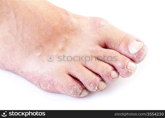 single male foot with eczema isolated on white background