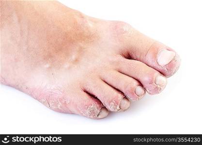 single male foot with eczema isolated on white background