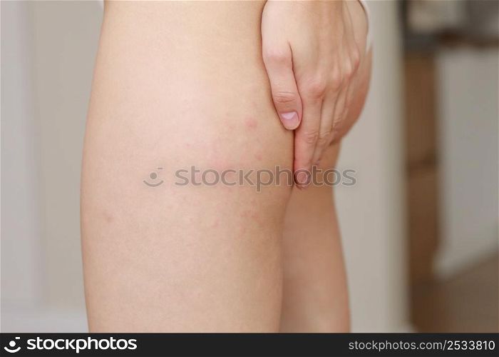 skin allergies, hips skin women. Closeup of red pustules on a hips, an allergic reaction caused by atopic dermatitis. Selected focus.. skin allergies, hips skin women. Closeup of red pustules on a hips, an allergic reaction caused by atopic dermatitis. Selected focus