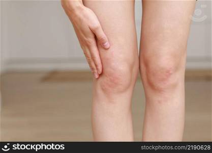 skin allergies, legs skin women. Closeup of red pustules on a knee, an allergic reaction caused by atopic dermatitis. Selected focus.. skin allergies, legs skin women. Closeup of red pustules on a knee, an allergic reaction caused by atopic dermatitis. Selected focus