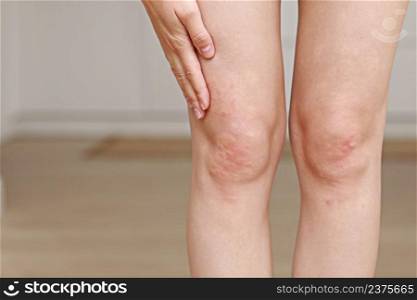 skin allergies, legs skin women. Closeup of red pustules on a knee, an allergic reaction caused by atopic dermatitis. Selected focus.. skin allergies, legs skin women. Closeup of red pustules on a knee, an allergic reaction caused by atopic dermatitis. Selected focus