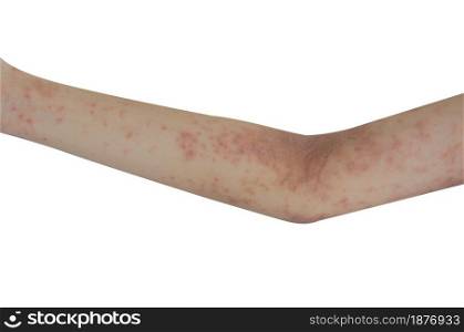 Skin rash on the arms isolated a white background. health care concept