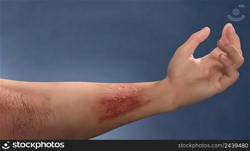 Skin sore, itching and scar Anatomical structure of the skin. Skin sore, itching and scar