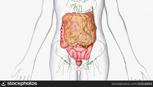 Stage III ovarian cancer has spread beyond the pelvis area to the abdomen. 3D rendering. Stage III ovarian cancer has spread beyond the pelvis area to the abdomen.