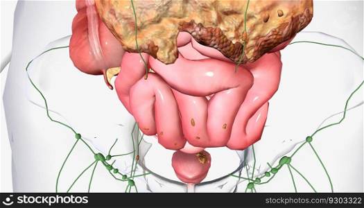 Stage III ovarian cancer has spread beyond the pelvis area to the abdomen. 3D rendering. Stage III ovarian cancer has spread beyond the pelvis area to the abdomen.