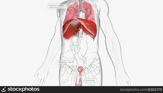 Stage III testicular cancer is characterized by spread to distant lymph nodes or any solid organ. 3D rendering. Stage III testicular cancer is characterized by spread to distant lymph nodes or any solid organ.