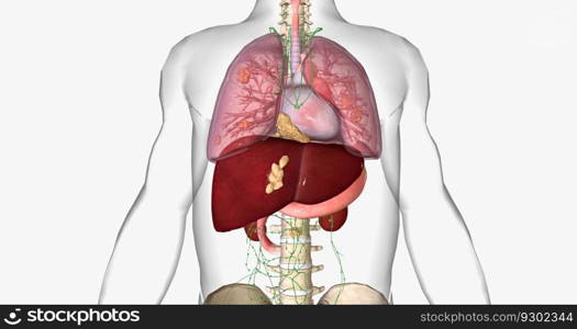 Stage IV cancer often spreads to the lungs, liver, and bones. 3D rendering. Stage IV cancer often spreads to the lungs, liver, and bones.