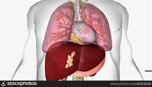 Stage IV cancer often spreads to the lungs, liver, and bones. 3D rendering. Stage IV cancer often spreads to the lungs, liver, and bones.