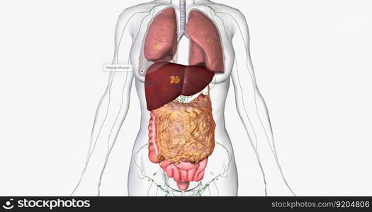 Stage IV ovarian cancer has spread to distant sites such as the lungs and liver. 3D rendering. Stage IV ovarian cancer has spread to distant sites such as the lungs and liver.