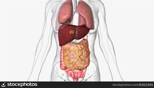 Stage IV ovarian cancer has spread to distant sites such as the lungs and liver. 3D rendering. Stage IV ovarian cancer has spread to distant sites such as the lungs and liver.