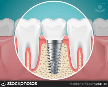 Stomatology illustrations. Dental implants and healthy teeth. Vector health tooth and implant stomatology, dentistry installation and fixture. Stomatology illustrations. Dental implants and healthy teeth