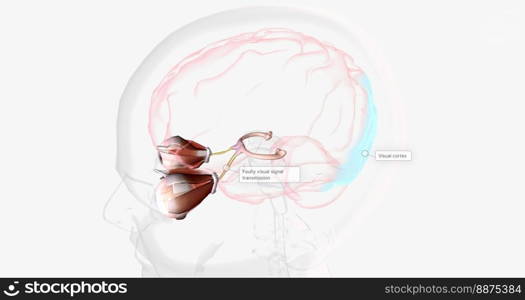 Strabismic Amblyopia, Visual Pathway with Eye Movement 3D rendering. Strabismic Amblyopia, Visual Pathway with Eye Movement