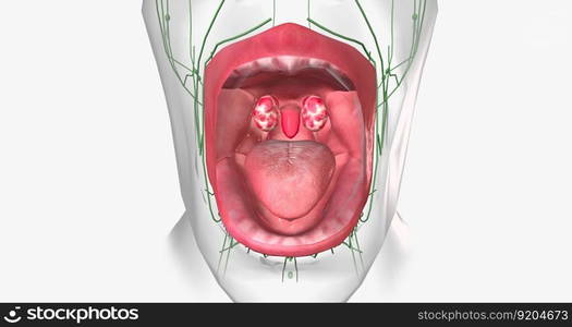 Strep throat is a common condition caused by a bacterial infection of the mouth and back of the oral cavity. 3D rendering .. Strep throat is a common condition caused by a bacterial infection of the mouth and back of the oral cavity.