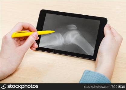 student analyzes X-ray picture of human knee-joint on screen on tablet pc