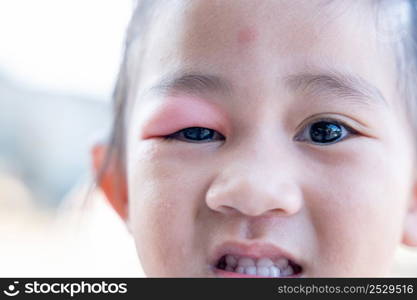 Stye Eye diseases. Closed Asian kid little girl eye with sty, eyelid abscess ophthalmic hordeolum