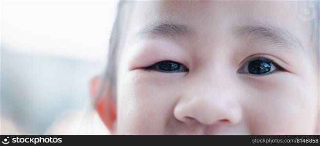 Stye Eye diseases. Closed Asian kid little girl eye with sty, eyelid abscess ophthalmic hordeolum