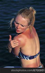 sunburnt woman