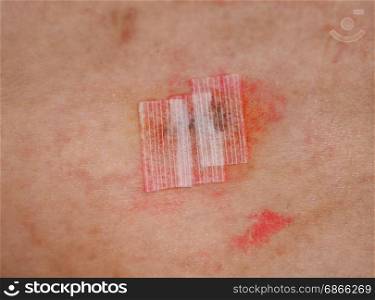 surgical wound with steri strips and iodine tincture. surgical wound with steri strips microporous surgical tape after removal of stitches and antiseptic iodine tincture