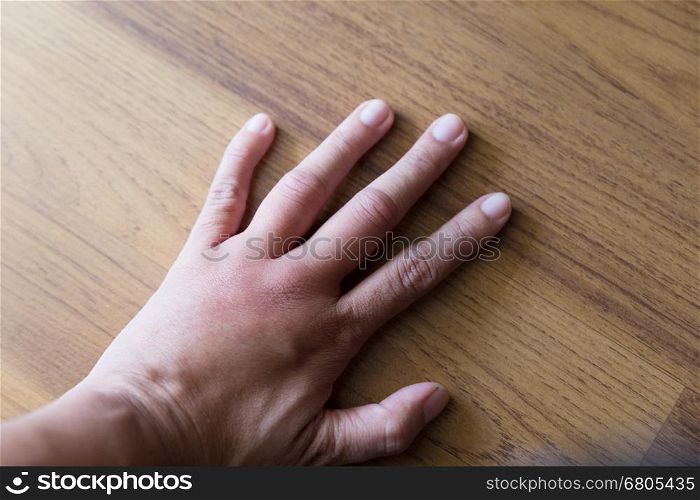 swollen hand from wasp insect sting
