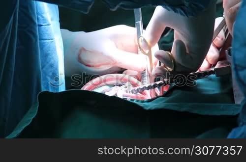 Team of medical doctors male and female surgeons in surgery operating a patient using different medical equipment instruments including forceps, tweezers and surgical scissors wearing scrubs and masks.