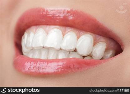 teeth with whitening tray smile dental