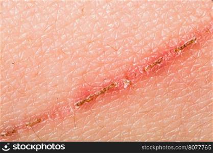 Texture of human skin and scratch. Extreme close up macro shot