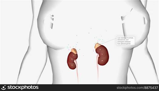 The Addison&rsquo;s Disease, Adrenal Gland 3D rendering. The Addison&rsquo;s Disease, Adrenal Gland
