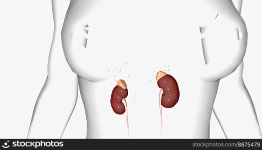 The Addison’s Disease, Adrenal Gland 3D rendering. The Addison’s Disease, Adrenal Gland