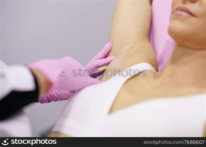 The doctor makes intramuscular injections of botulinum toxin in the underarm area against hyperhidrosis. Cosmetology skin care. Doctor makes intramuscular injections of botulinum toxin in the underarm area against hyperhidrosis.