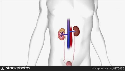 The Kidney Cancer, Stage II 3D rendering. The Kidney Cancer, Stage II