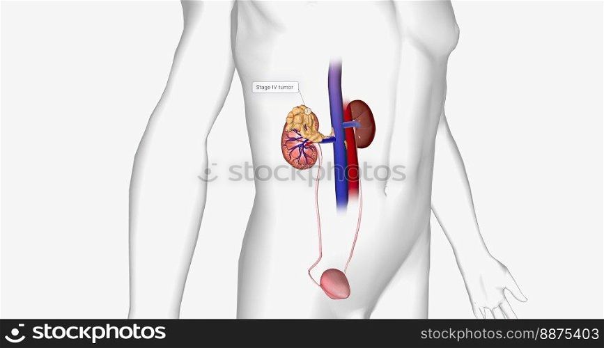 The Kidney Cancer, Stage IV 3D rendering. The Kidney Cancer, Stage IV