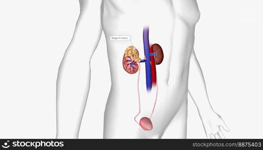 The Kidney Cancer, Stage IV 3D rendering. The Kidney Cancer, Stage IV