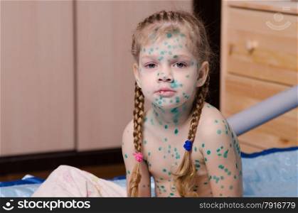 The little girl suffering from chicken pox is covered by green dots. The little girl suffering from chicken pox all smeared zelenkoj