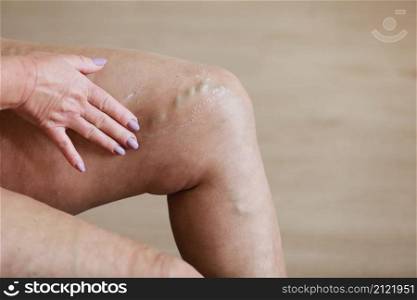 The woman rubs tired legs with a special cream to reduce pain. Phlebology. Painful varicose and spider veins on active female legs, medicine and health. The woman rubs tired legs with a special cream to reduce pain. Phlebology. Painful varicose and spider veins on active female legs, medicine and health.